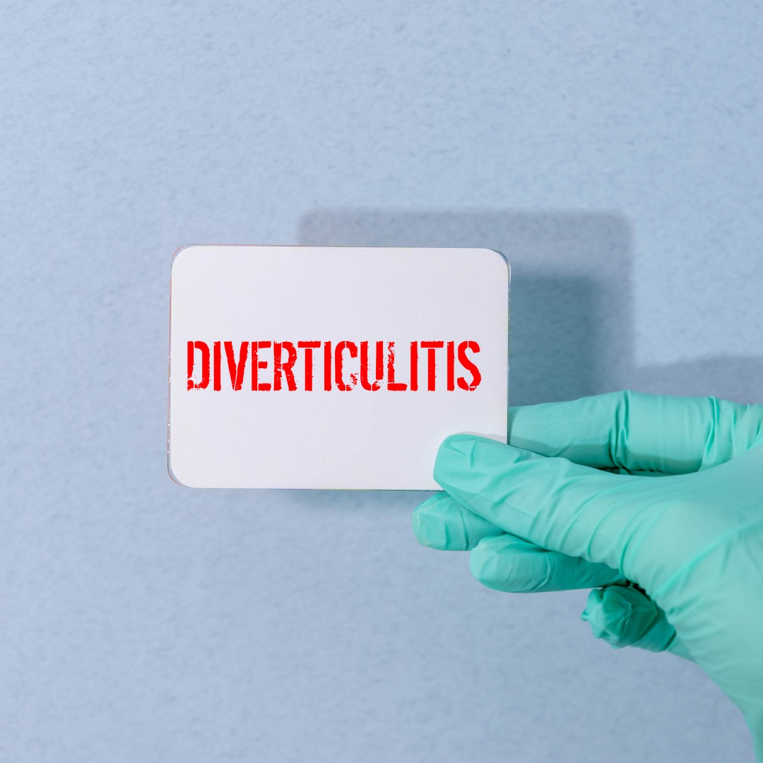 What Is Diverticulitis and How Does It Affect Your Digestive System?