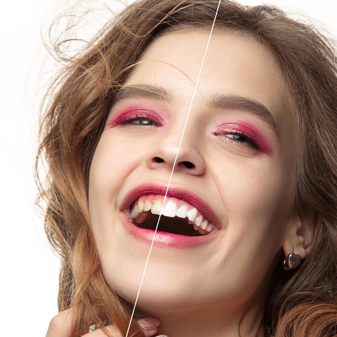 Is GLO Teeth Whitening Suitable for Everyone?