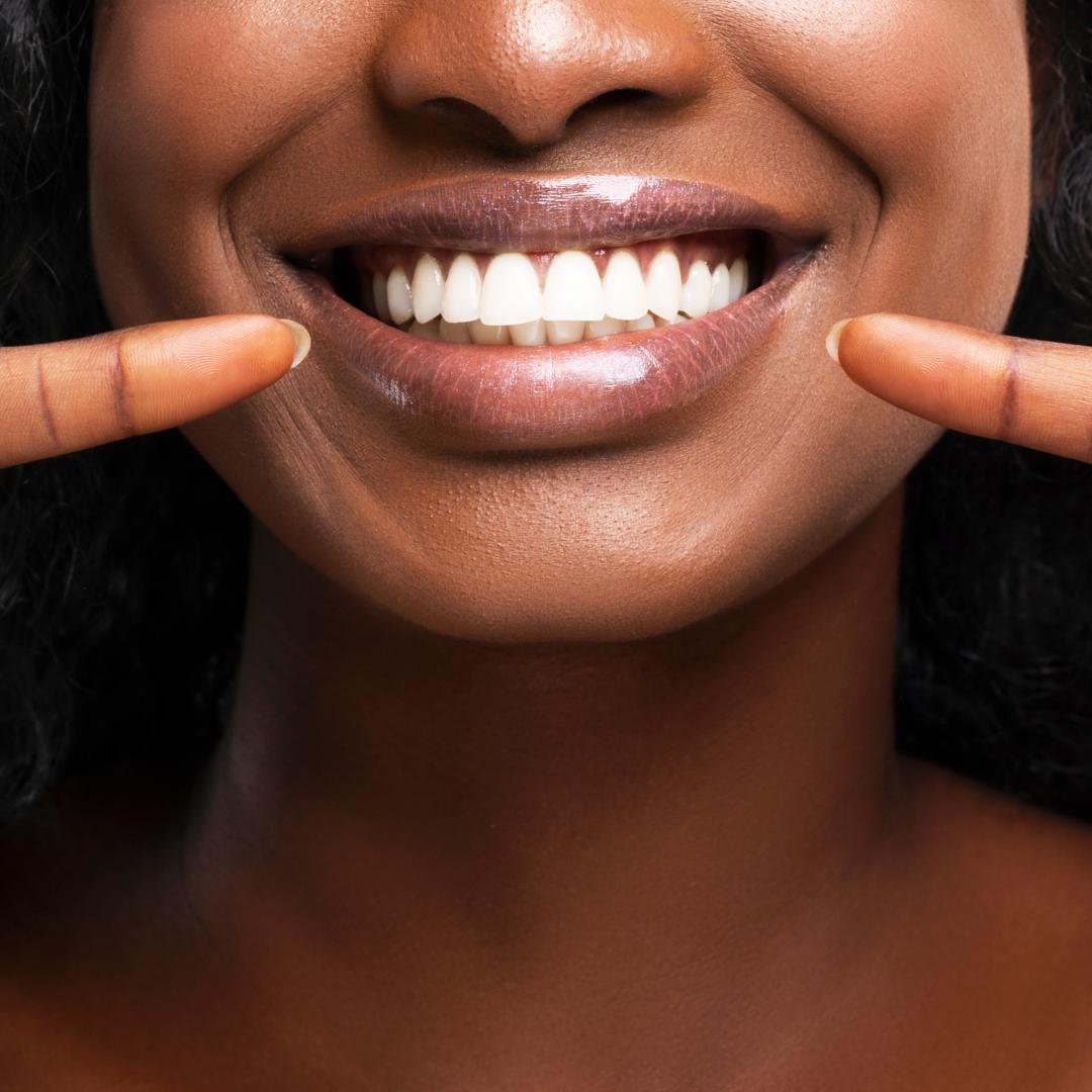How Is Teeth Bonding Different from Veneers?