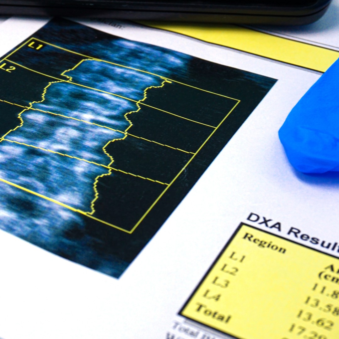 How Accurate Is a DEXA (Bone Density) Scan in Diagnosing Bone Conditions?