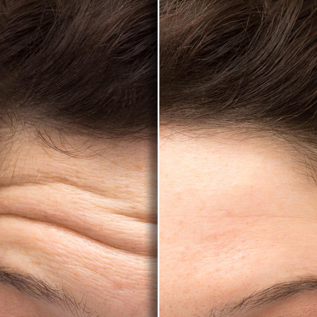How Does PRP Facial Injections Stimulate Collagen Production?