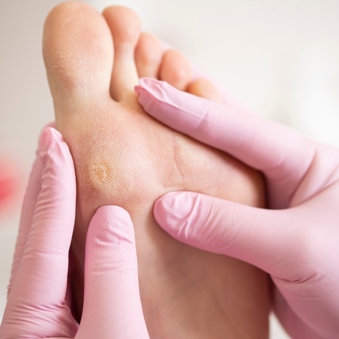 What Are the Common Causes of Foot Corns?