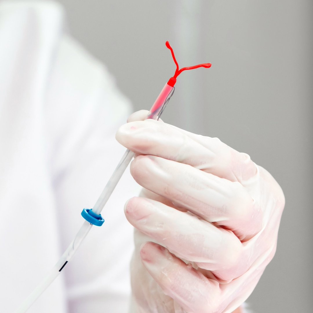 How Quickly Does an IUD Work to Prevent Pregnancy?