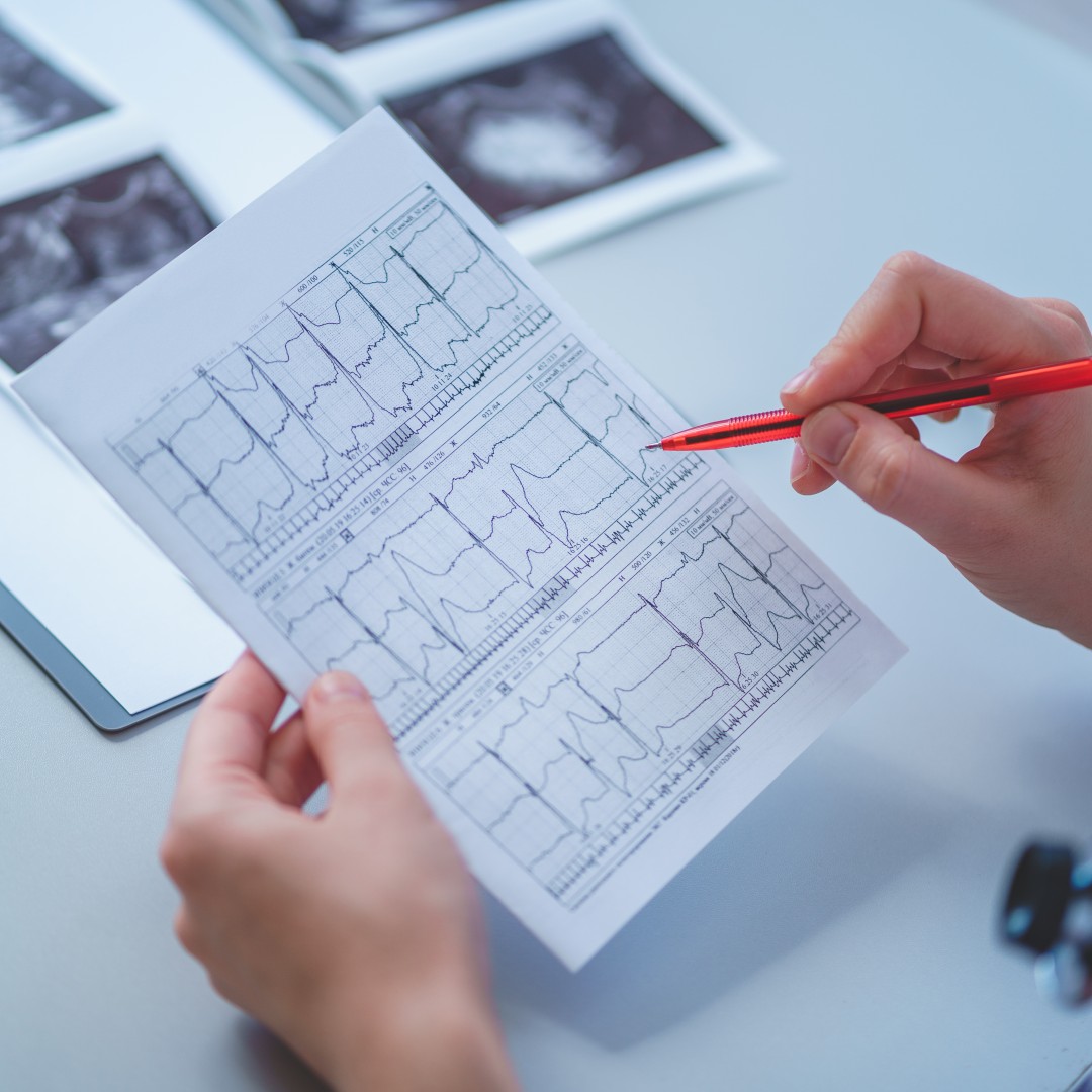 What Is an EKG and Why Is It Important for Heart Health?