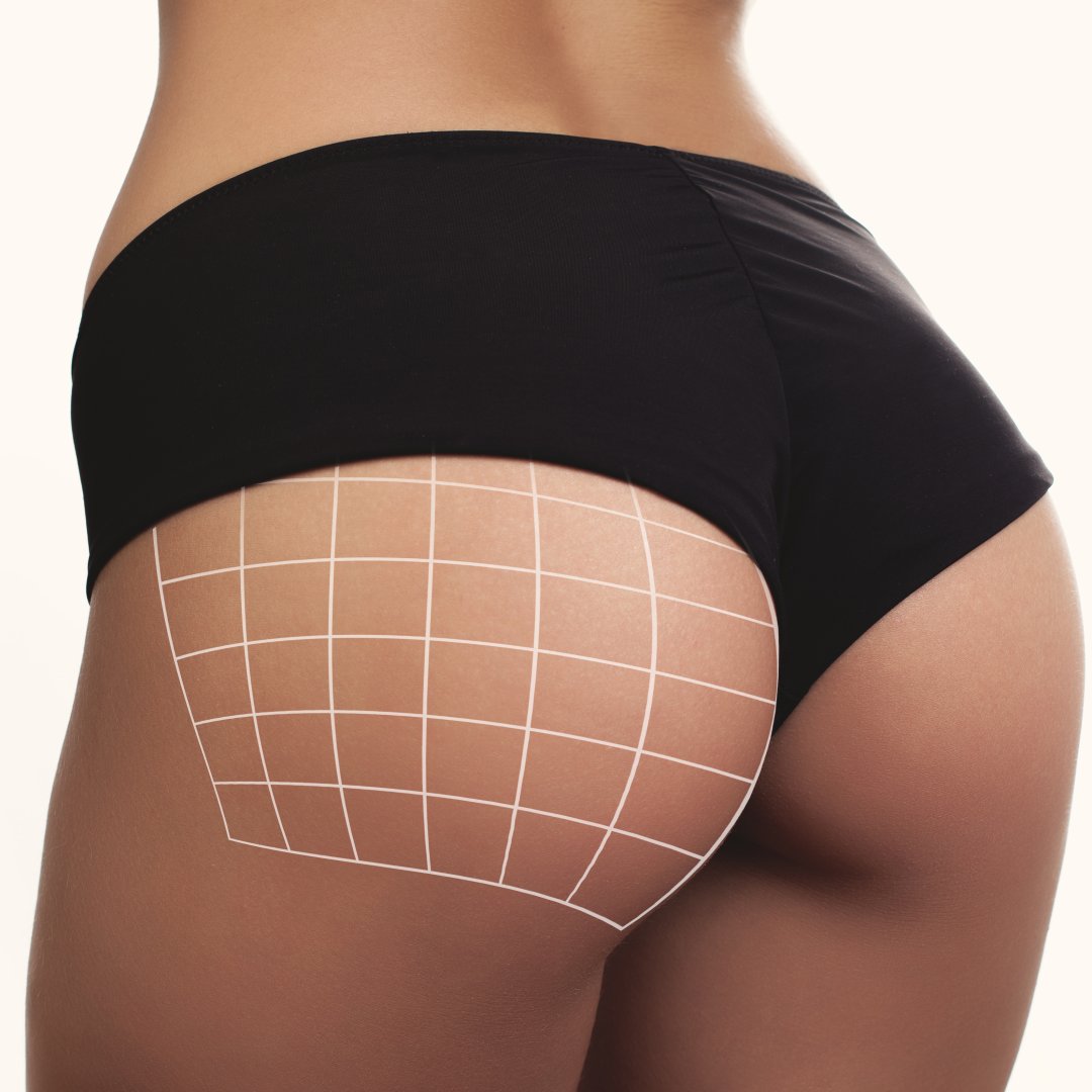 How Can You Achieve Long-Lasting Cellulite Reduction?